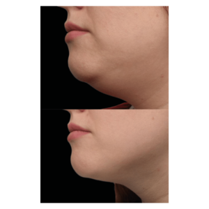 Emface Submentum treatement before and after.