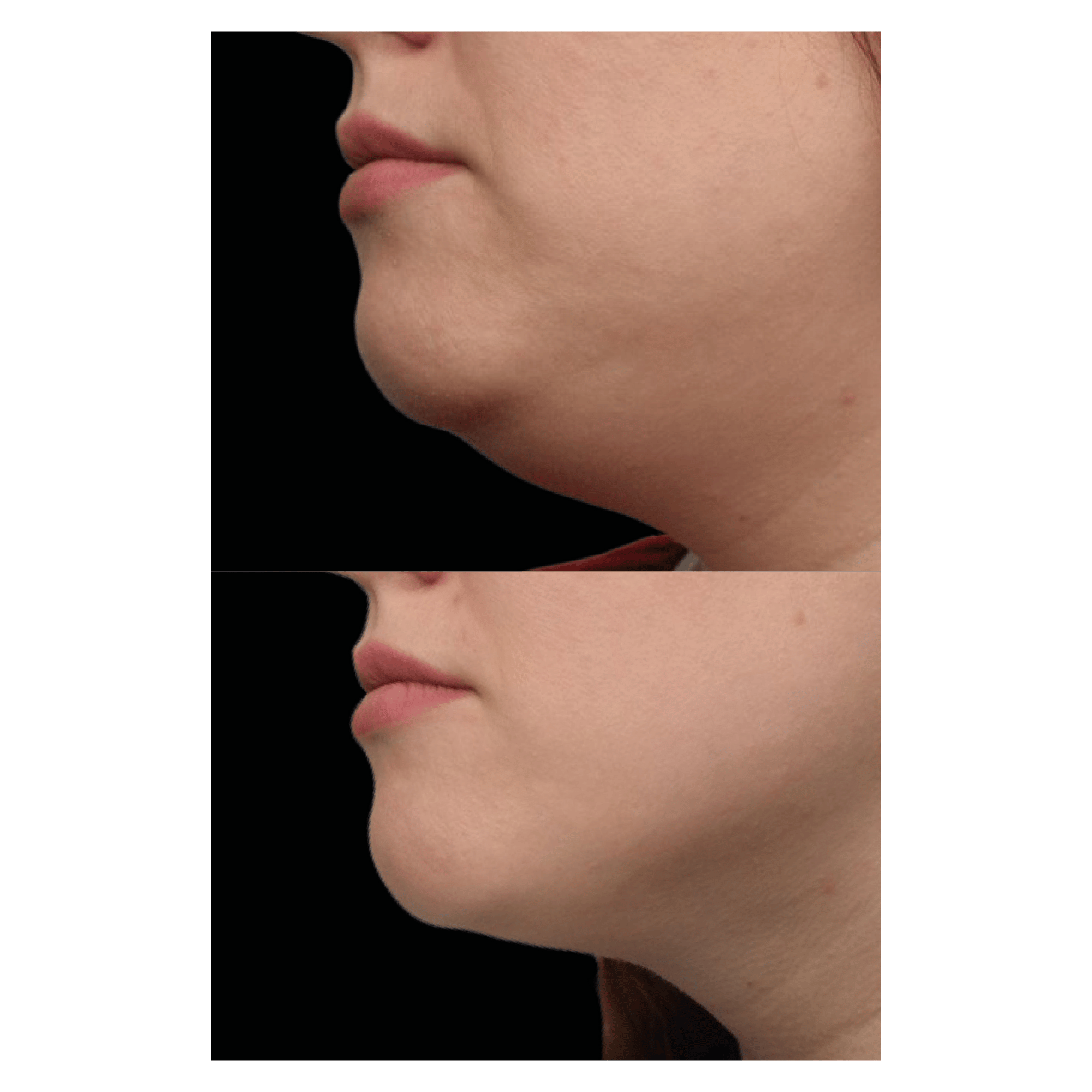 Emface Submentum treatement before and after.